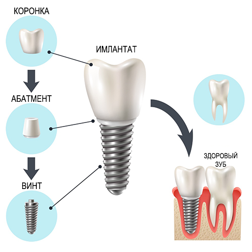 implant1